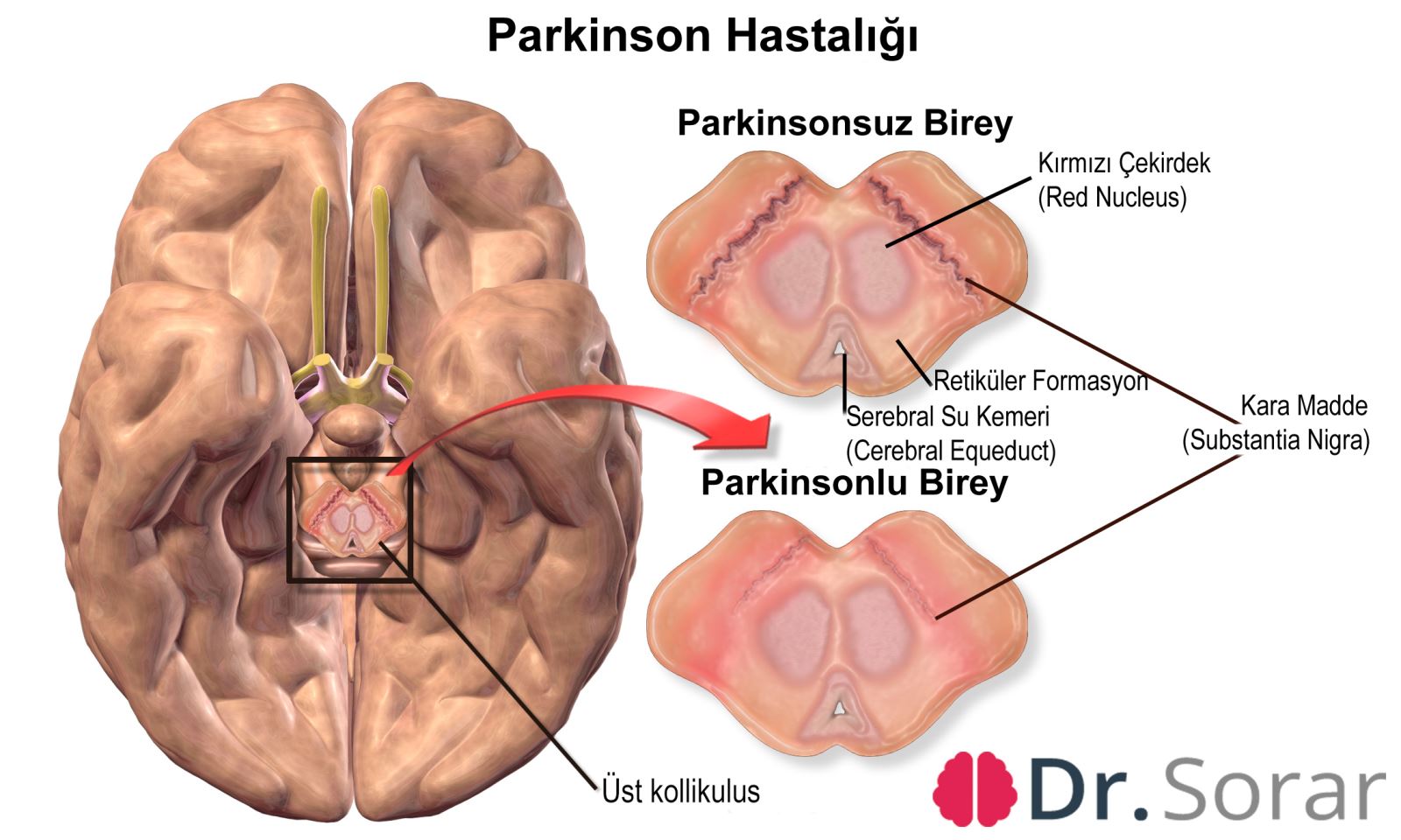 Parkinson Hastalığı Beyin Yapısı
