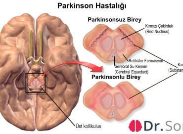 Parkinson