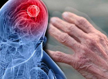 Parkinson Tedavisinde Yeni Çözüm Arayışları